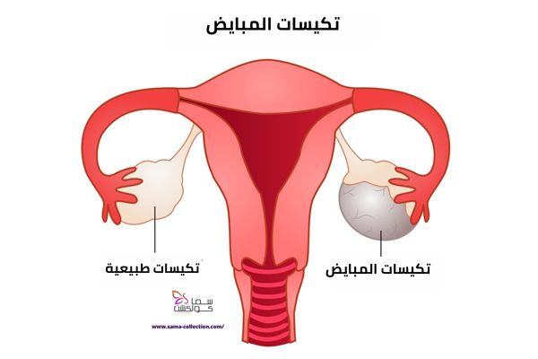 أسباب تأخر الدورة الشهرية - تكيسات المبايض-Ovarian cysts
